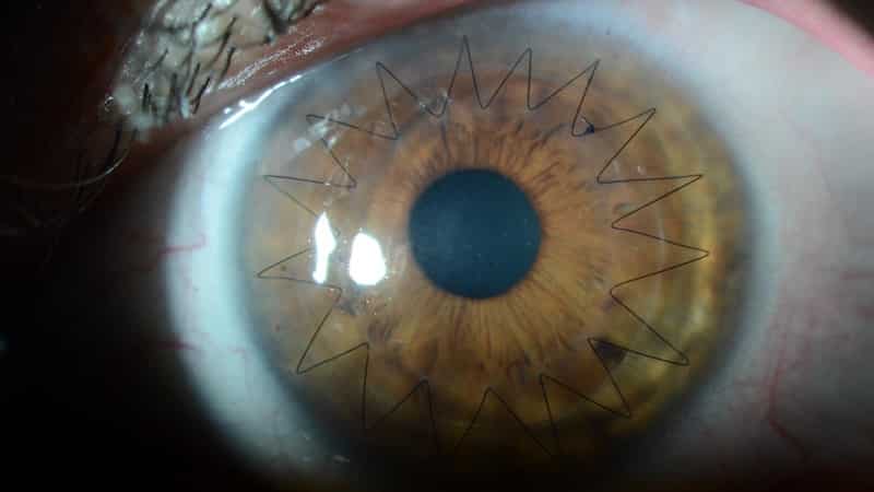 Before and After - Corneal Transplant