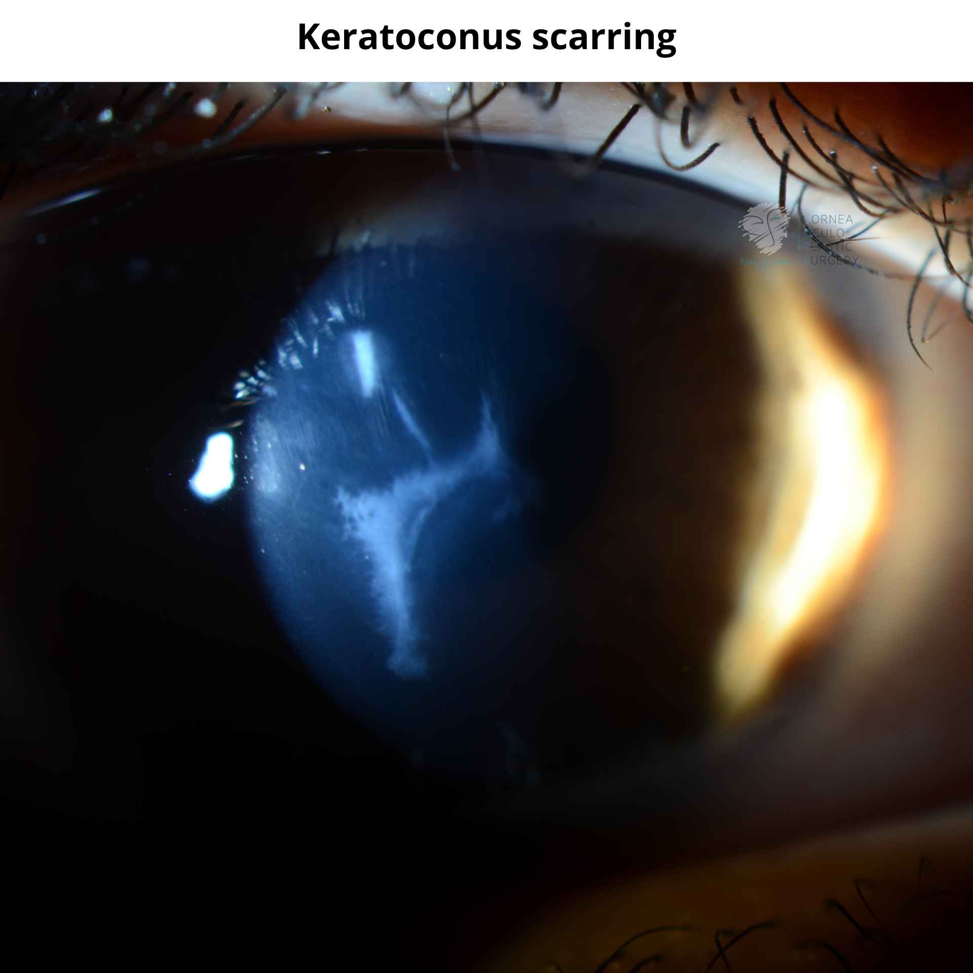 Keratoconus scarring