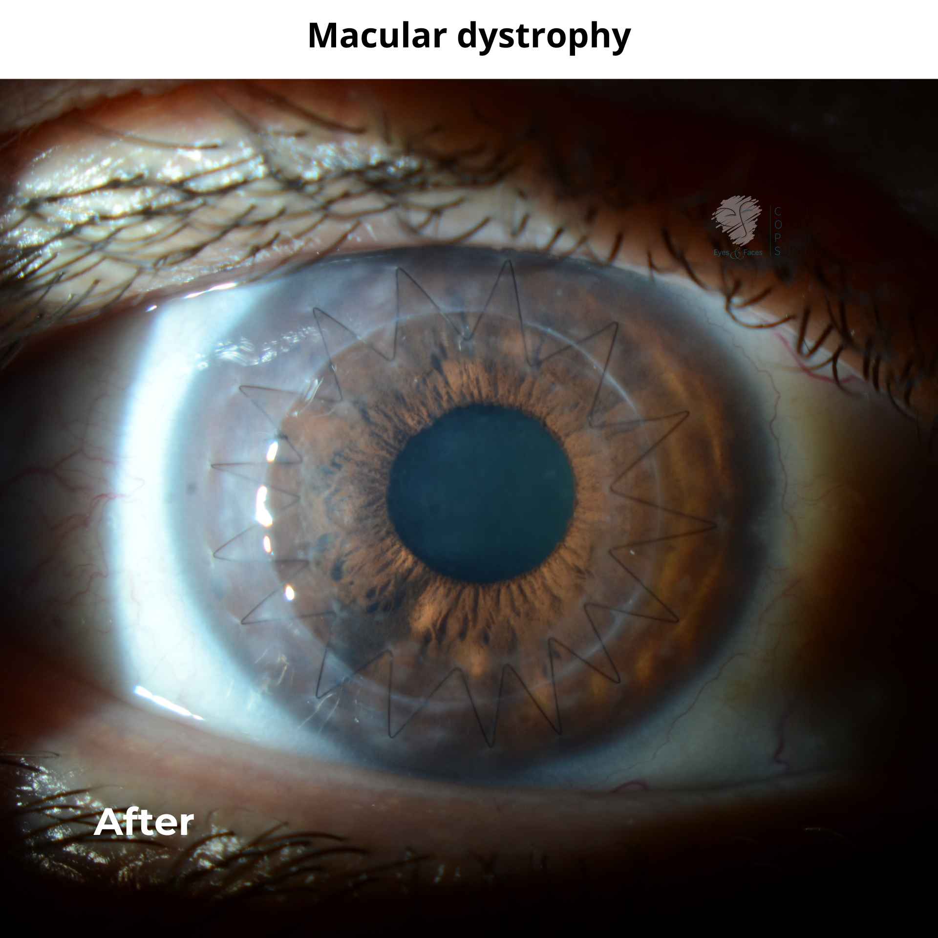 Corneal transplant to rectify macular dystrophy. Dr Anthony Maloof, Sydney performed the surgery.