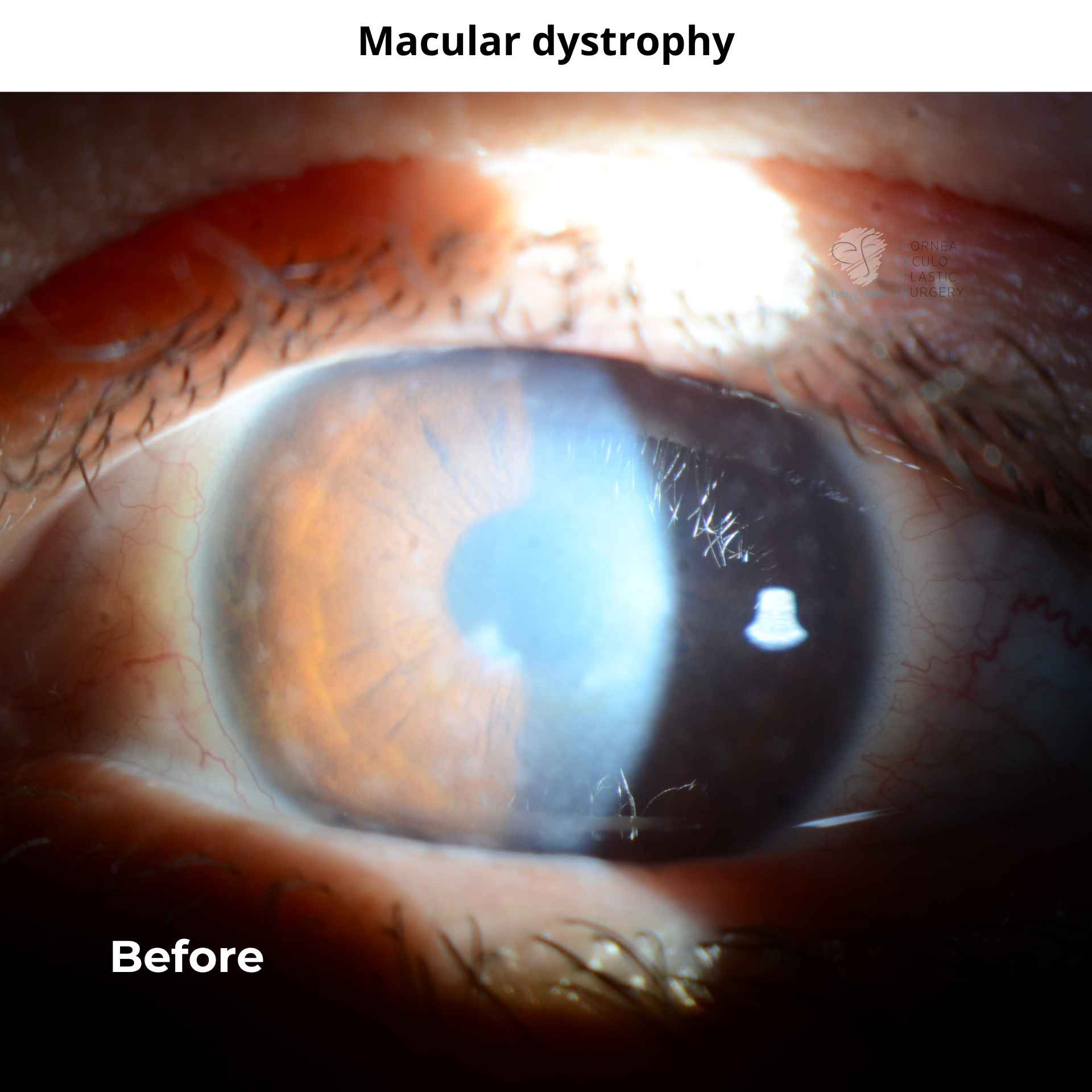 Macular Dystrophy - Dr Anthony Maloof, Sydney.