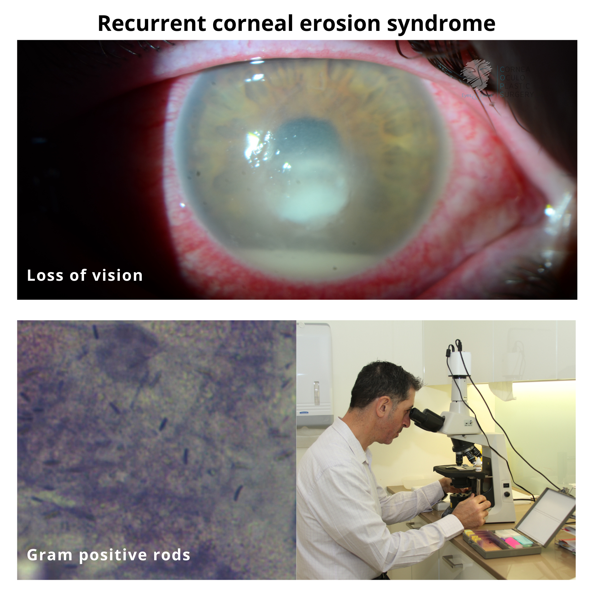 Recurrent corneal erosion syndrome with Dr Anthony Maloof looking under a microscope.