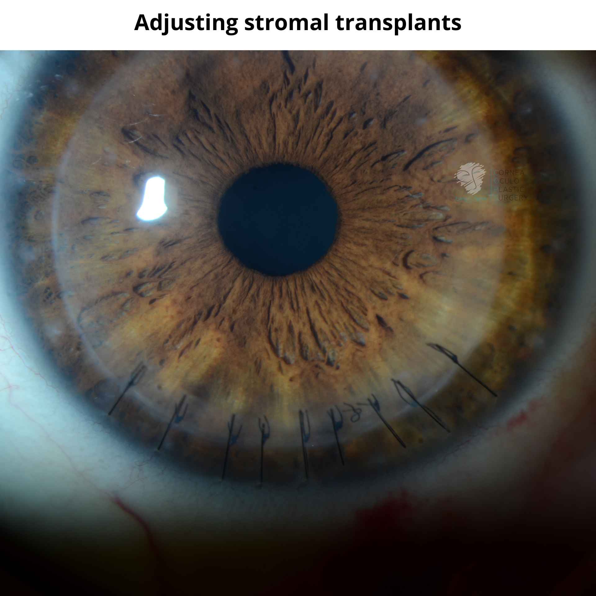 Stromal transplant