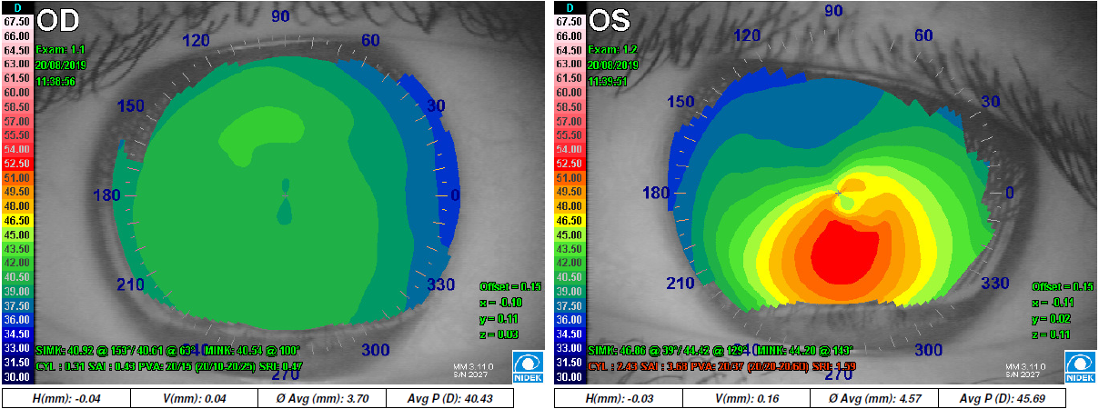 Corneal topography showing advanced Keratoconus on the right image.
