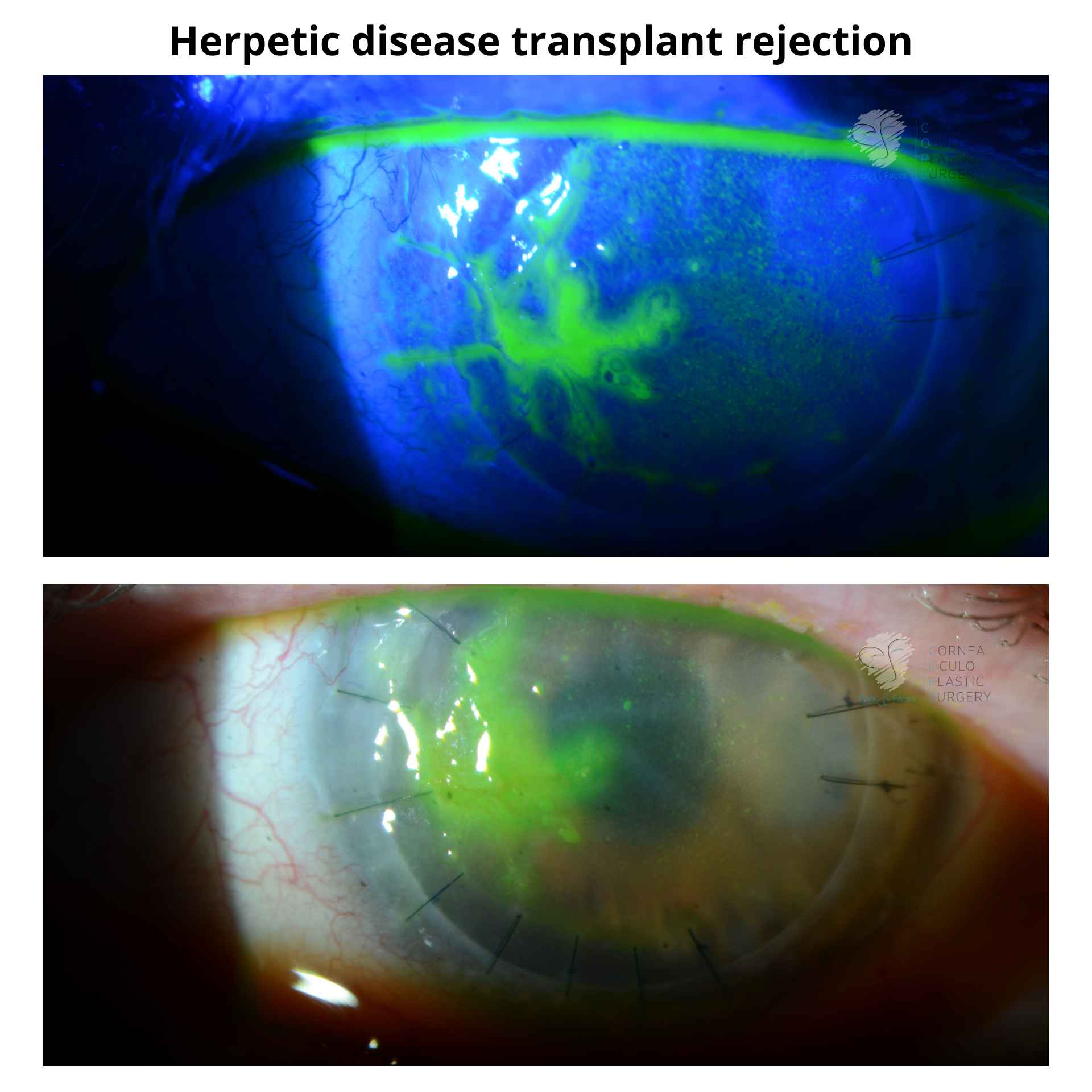 Herpetic disease transplant rejection
